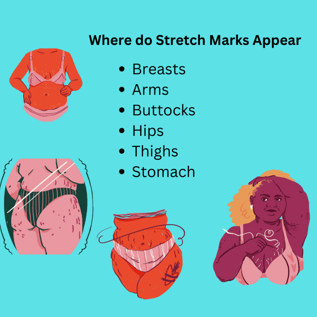 Where do Stretch Marks Appear